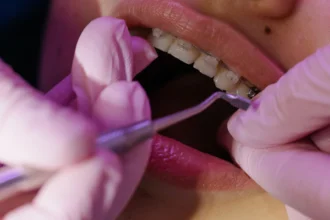 Do I Actually Need Braces